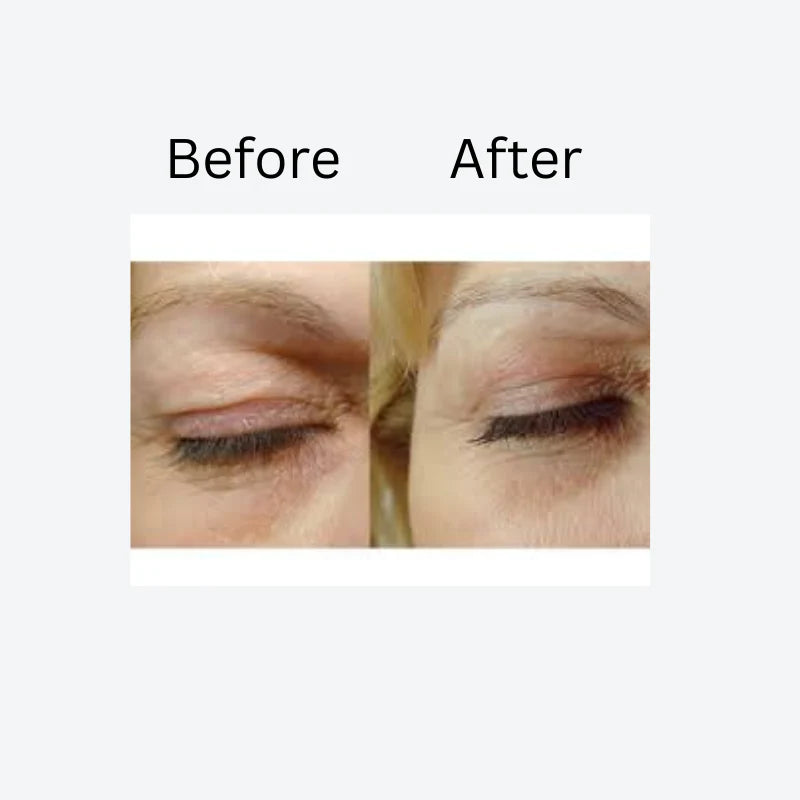 Lid Lifting Treatment
