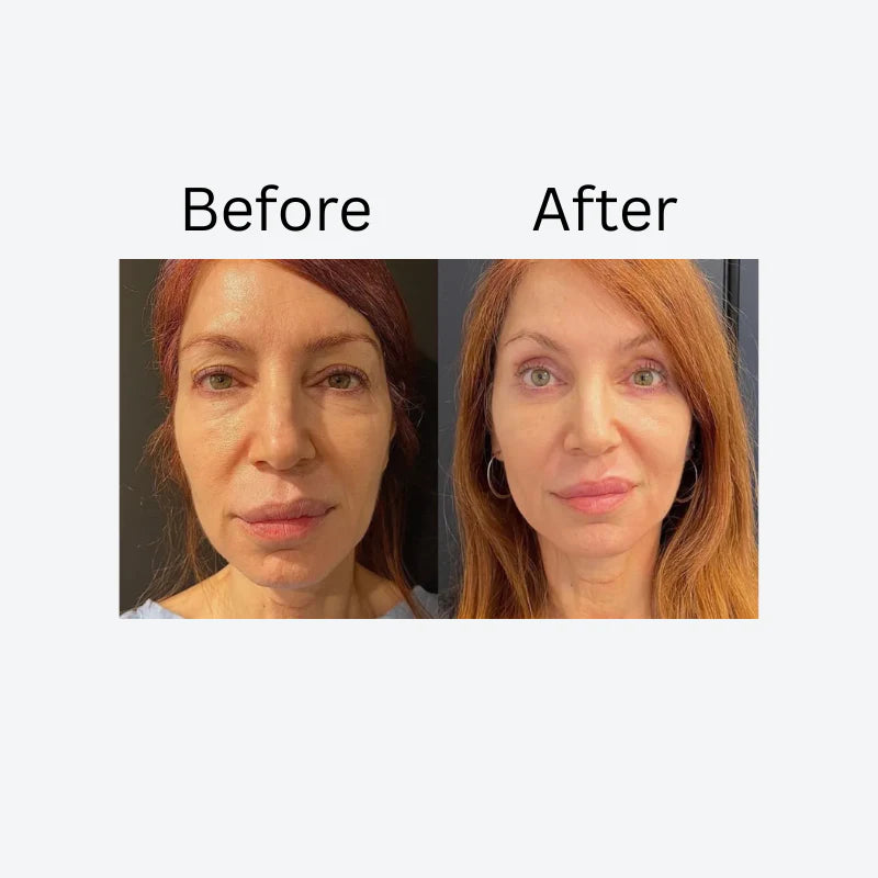 Lid Lifting Treatment